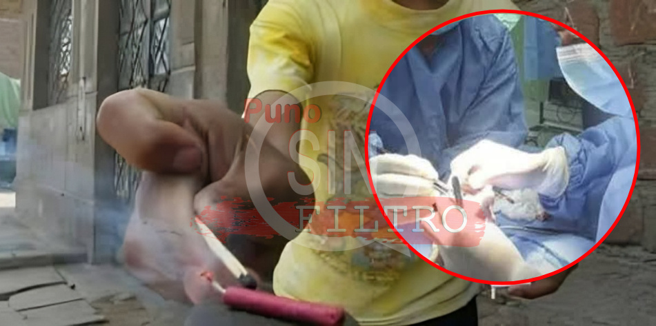 Niño perdió Nueve Dedos y Sufre Graves Lesiones Oculares tras Explosión de Pirotécnico